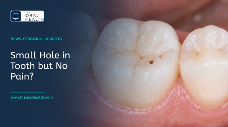 Small Hole in Tooth but no pain